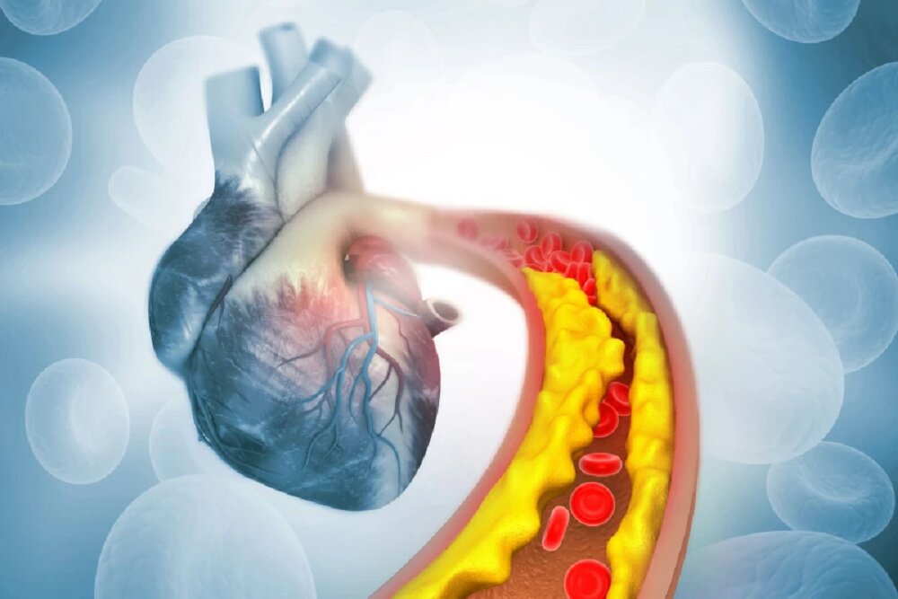 ویرایش ژن؛ انقلاب علمی در کاهش چربی خون